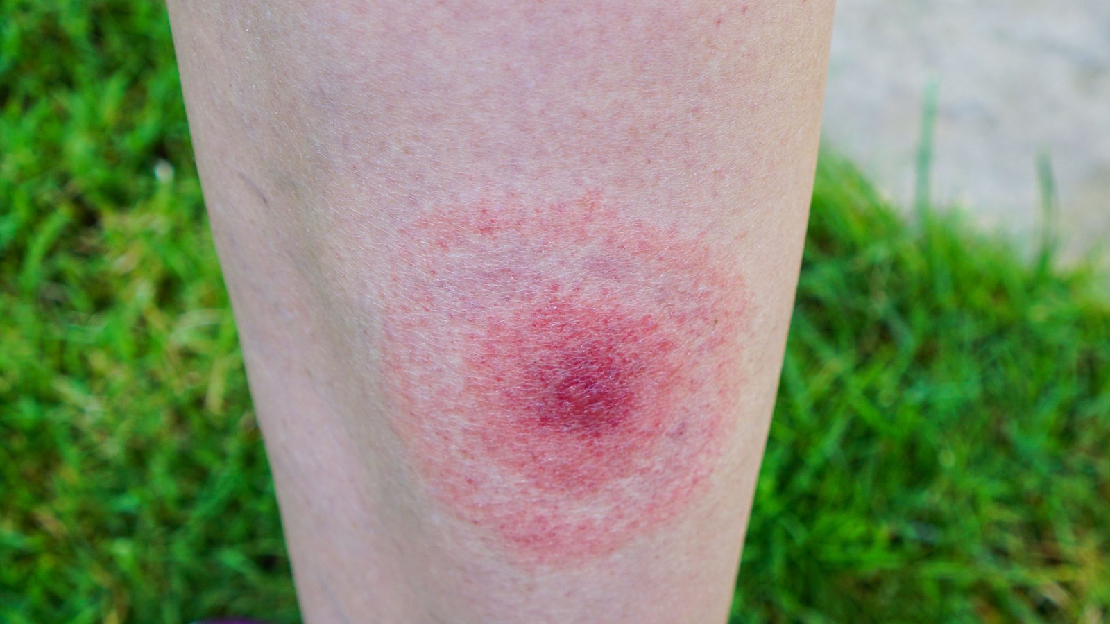 Borreliose